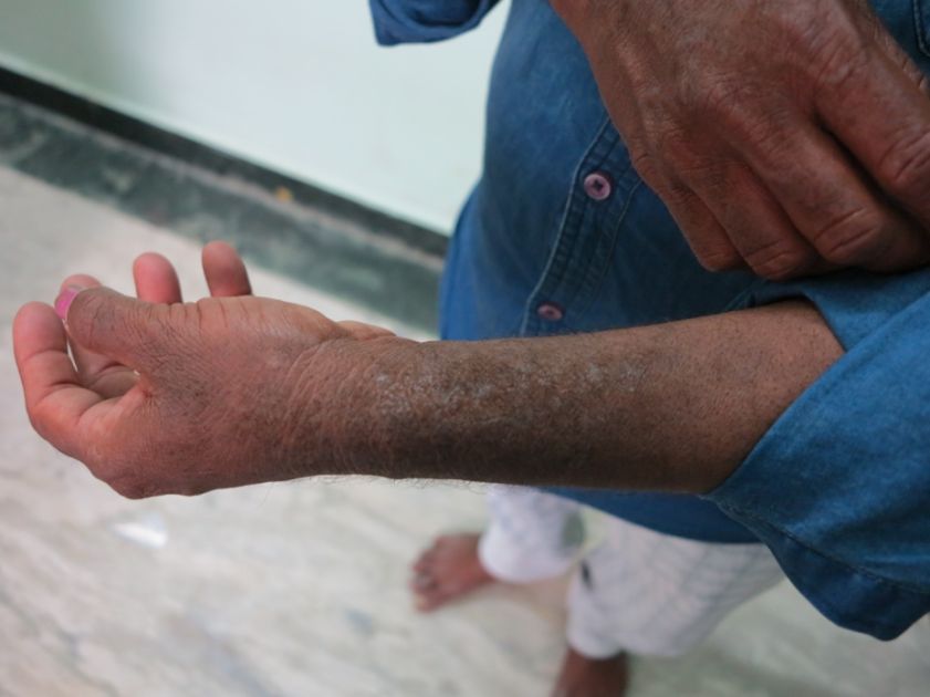 Ein Gerbereiarbeiter zeigt die arbeitsbedingten Hautkrankheiten an seinem Unterarm  | © INKOTA